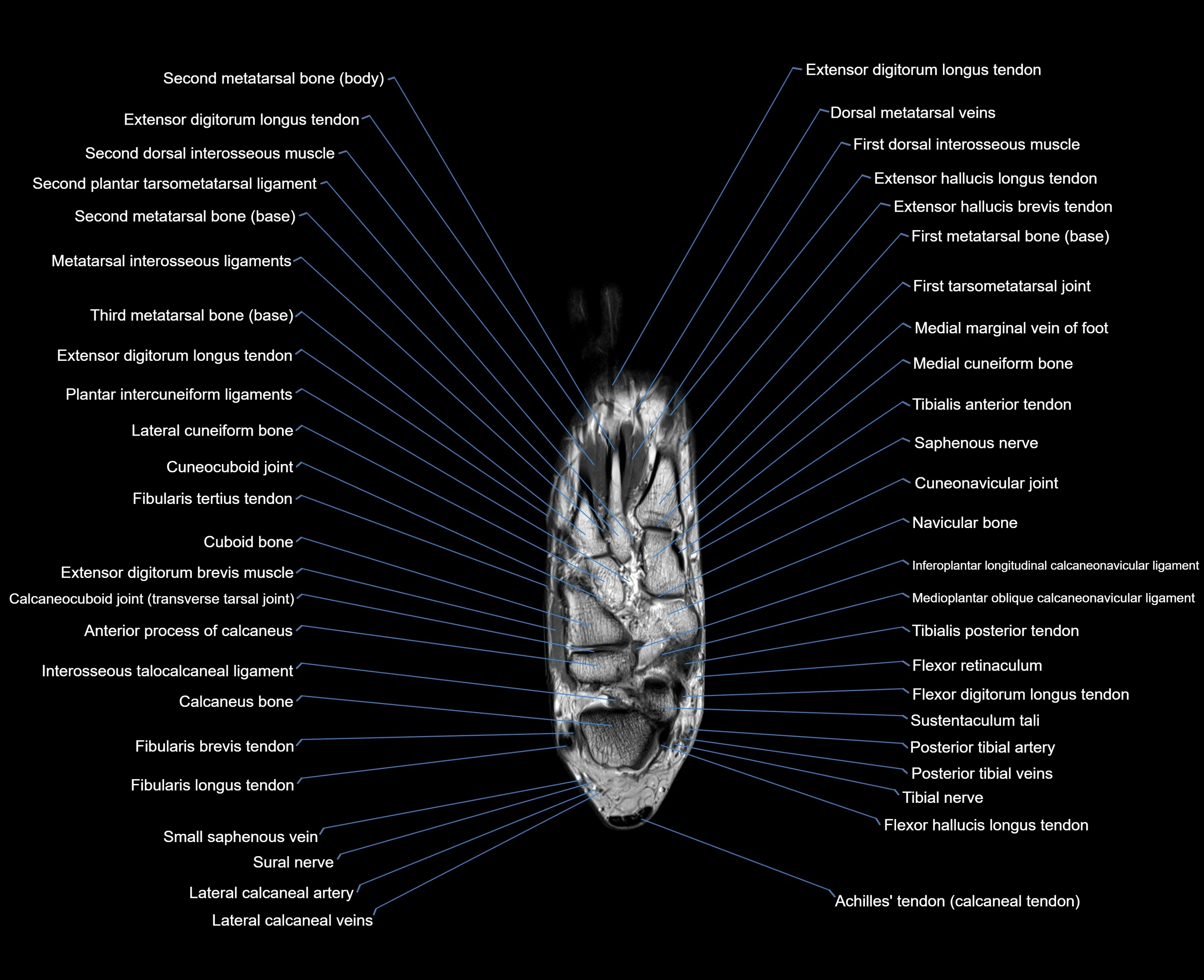 MRI foot coronal cross sectional anatomy 3T  radiology  image-img-00001-00017.webp